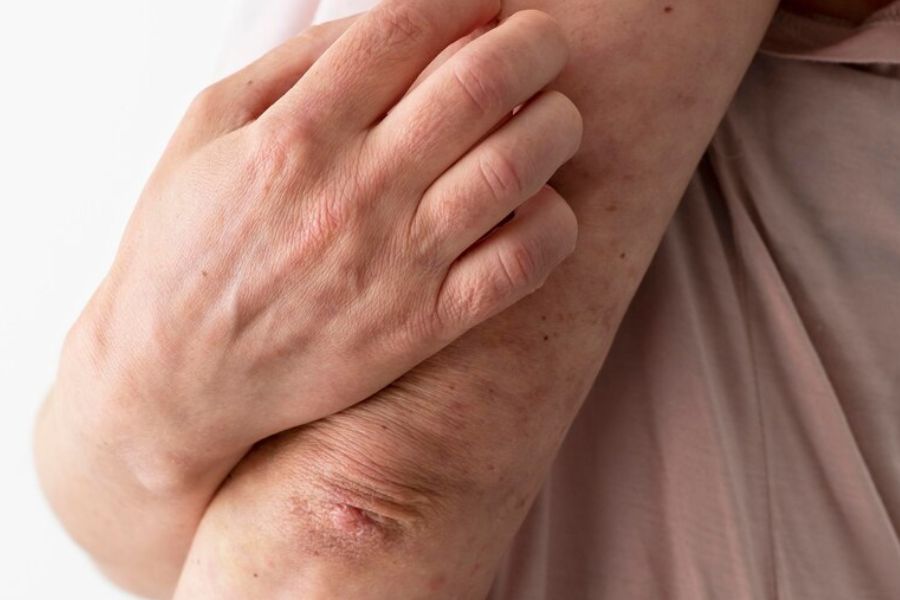 Có nhiều nguyên nhan gây ra nám da tay.